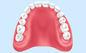 レジン床義歯（保険適応義歯）